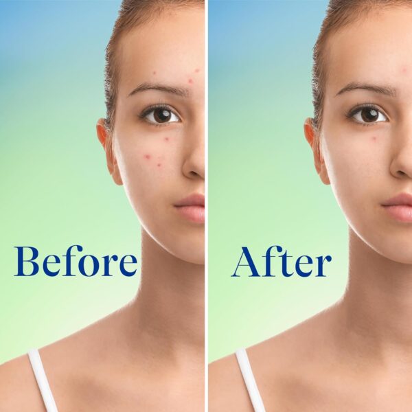 Differin Acne Face Wash with 10% Benzoyl Peroxide, Maximum Strength OTC Acne Foaming Cleanser, Fast Acting Acne Treatment for Face and Body, 5 oz - Image 7